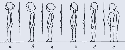 Виды осанки: а) правильная осанка; б) сутулая осанка; в) кифотическая осанка; г) лордотическая осанка; д) выпрямленная осанка; е) нарушение осанки во фронтальной плоскости